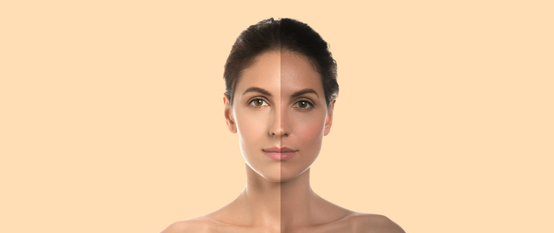 Easy & Effective Home Remedies To Remove Sun Tan